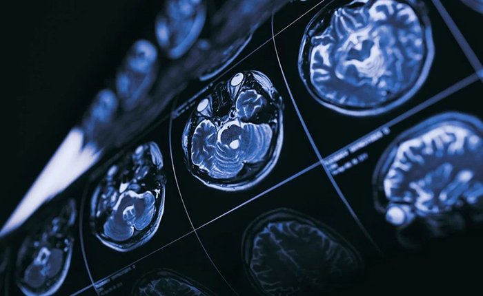 Structural MRI Study (D'Arcy et al., 2019)